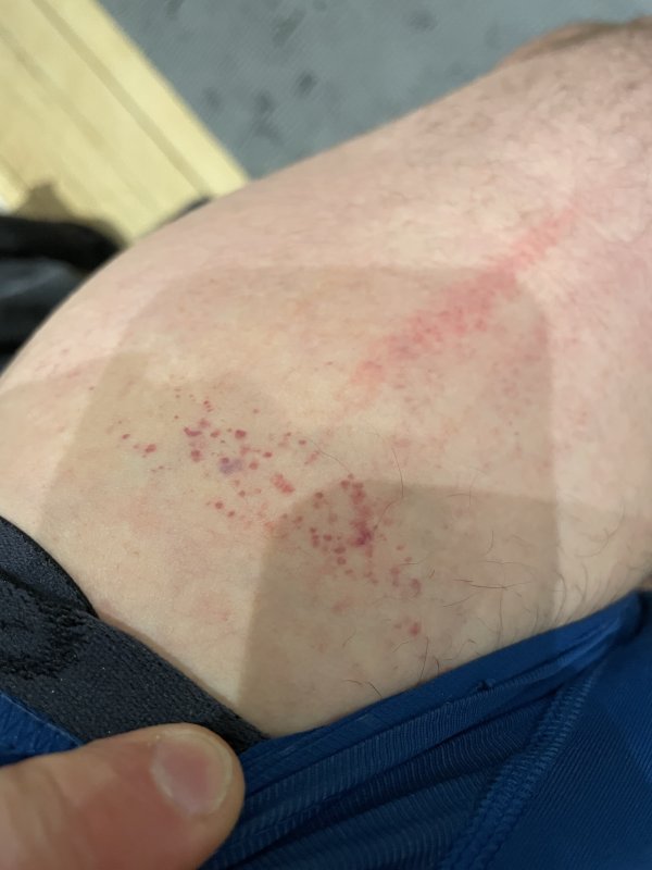 Taches de sang sous cuntané